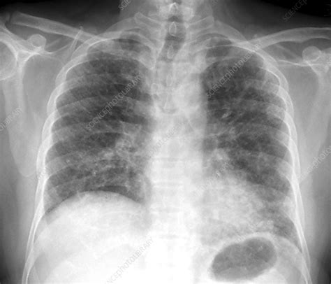 Pulmonary Fibrosis Chest X Ray Stock Image C Science