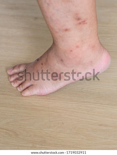 Skin Diseases Skin Wounds On Legs ภาพสต็อก 1719032911 Shutterstock