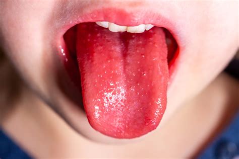 Scarlet Fever Overview Causes Symptoms Treatment Illness