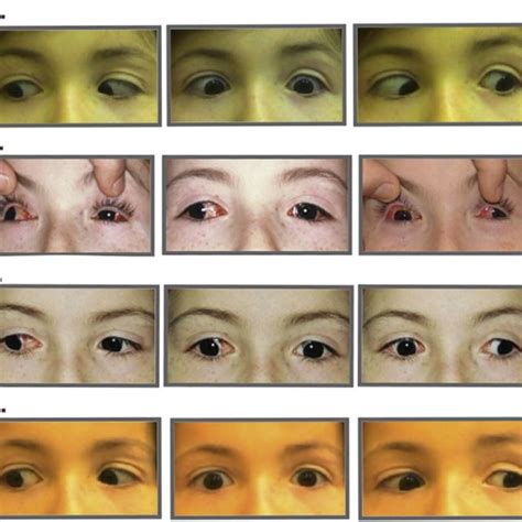 Case 1 A Parinaud Syndrome Right Esotropia And Cerebral Palsy B