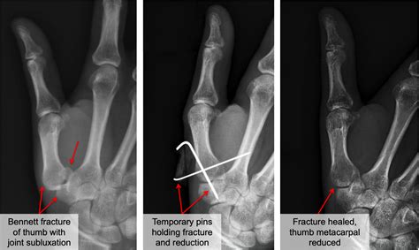 Bennett Fracture Raleigh Hand Surgery — Joseph J Schreiber Md