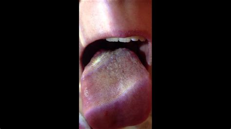 Red Bumps On Back Of Tongue Youtube