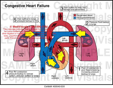 Congestive Heart Failure Medical Illustration Medivisuals