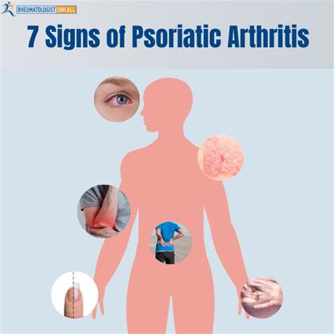 Psoriatic Arthritis Why Diagnosis Can Be Challenging