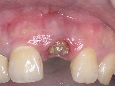 This Is Wisdom Tooth Extraction White Tissue 4 Tooth Bantuanbpjs