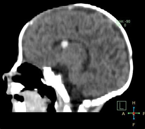 Germinal Matrix Hemorrhage Causes Symptoms Diagnosis Treatment