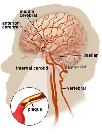 Intracranial Artery Stenosis Mayfield Brain Spine Cincinnati Ohio