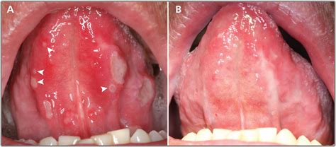 Aphthous Ulcers Tongue