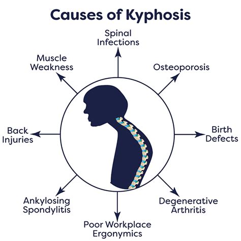 Kyphosis Treatment In Nj And Nyc Kyphosis Surgery In New Jersey
