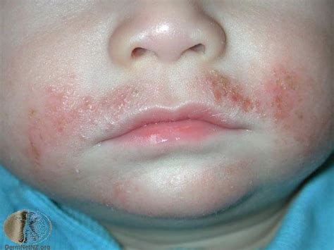 Common Skin Rashes And What To Do About Them Faculty Of Medicine