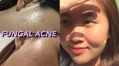 Fungal acne may look like regular acne or whiteheads however it is something totally different. SKINCARE FUNGAL ACNE & BERUNTUSAN - TANPA OBAT DOKTER ...