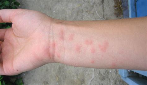 6 Rashes That Can Ruin Your Summer Cottage Life