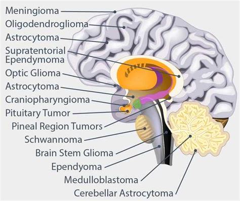 Brain Tumor Types Glioblastoma Meningioma And More