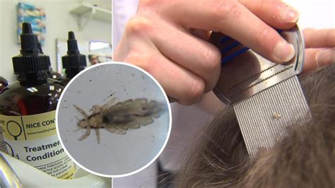 Head Lice Treatments Losing Effectiveness Against Super Lice Say