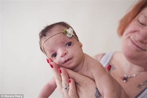 Baby Born With Treacher Collins Syndrome Is Abandoned By Adoptive Mum