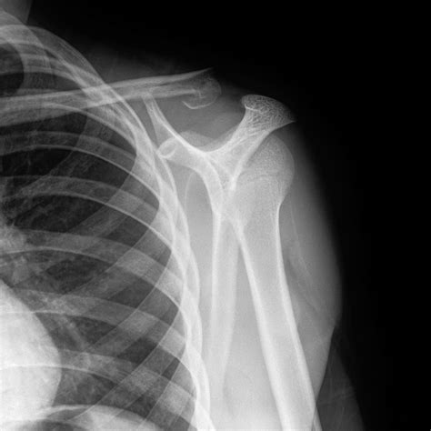 X Ray Normal Shoulder