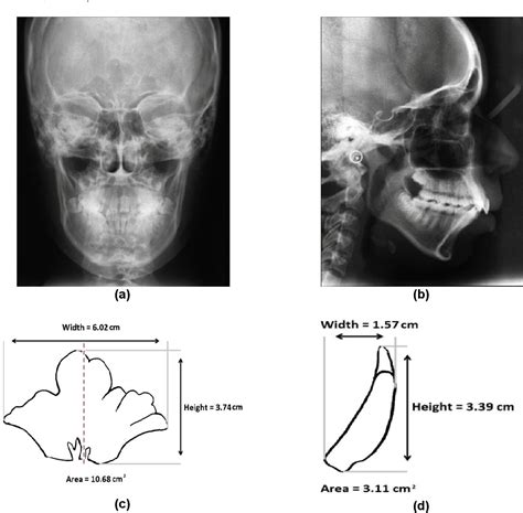 Figure 1 From Radiographic Evaluation Of Frontal Sinus Dimensions And