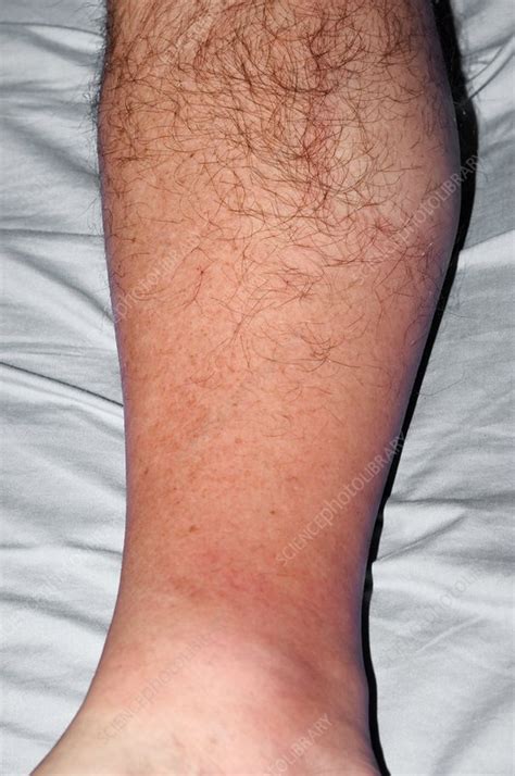 Cellulitis Of The Leg Stock Image C Science Photo Library
