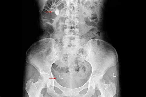 Radiografía De Un Paciente Con Cálculos Renales Y Ureterales Foto