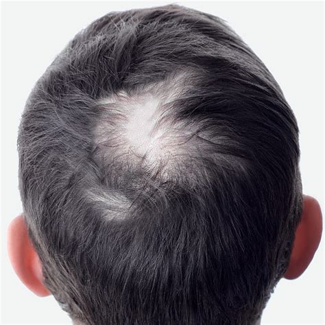 Crown Hair Thinning Identify And Stop It With These Steps