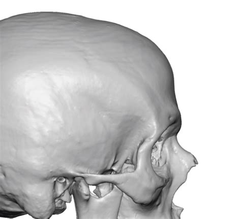 Anterior Sagittal Crest And Mnetopic Ridge 3d Ct Scan Side View