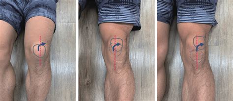 The J Sign Known As The Lateral Patellar Tracking On Anterior View