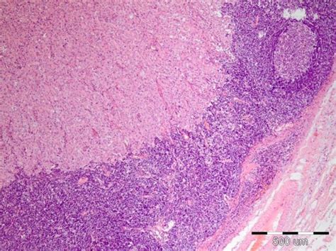Neck Lymph Node With A Metastatic Deposit From A Patient With