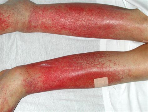 If the word meningitis makes you tremble, you're not alone. Red Spots on Legs Causes, Pictures Including Small, Itchy ...