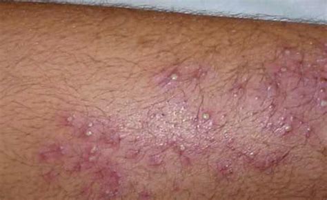 Itching, itchy, burning skin without a rash can be an anxiety symptom. Treat n Heal - Page 28 of 33 - Treat, heal, cure, get rid ...