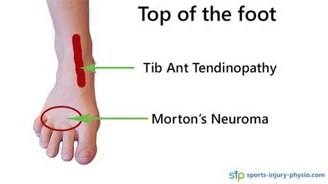Foot Pain In Runners A Quick Guide Sports Injury Physio