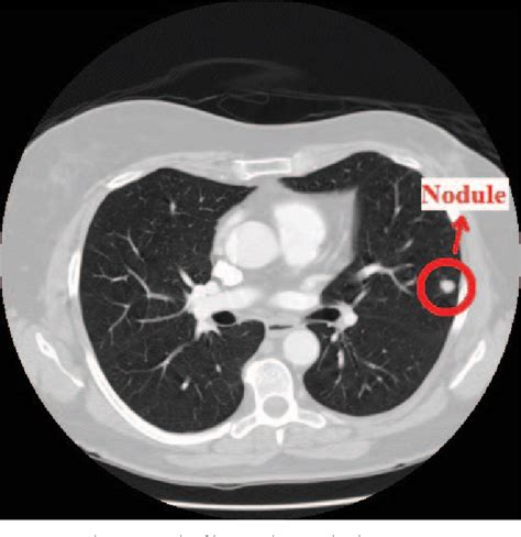 Figure From Lung Nodule Diagnosis From CT Images Based On Ensemble