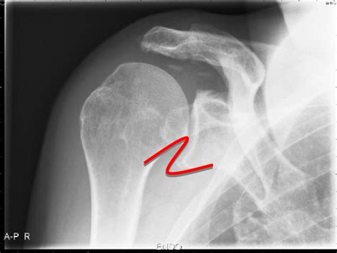 Radiograph Of The Right Shoulder Shows Cranial Migration Of The Humeral