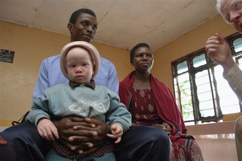 Albinism In Tanzania Witchcraft Fuelled Persecution Leads To