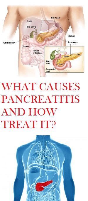 Learn What Causes Pancreatitis How Severe It Can Get And How To Treat
