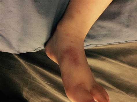 Unusual And Unexplained Bruising On Ods Update Kind Of Babycenter