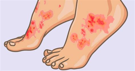 What Is Plaque Psoriasis Symptoms Causes And Treatments