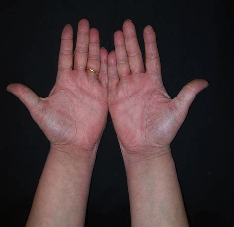 Successful Treatment Of Hand And Foot Psoriasis With Infliximab