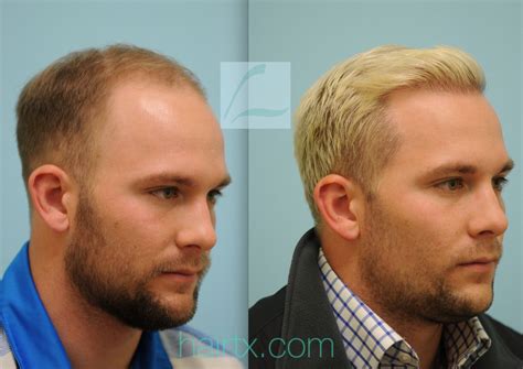 Pin By Hairtx On Male Hair Transplant Results Hair Transplant Hair