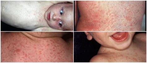 Roseola Infantum Causes Symptoms Diagnosis Treatment And Prevention