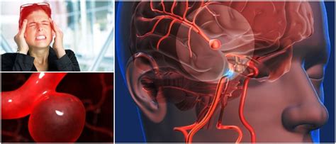 Aneurisma Cerebral Definici N Causas Factores De Riesgo S Ntomas