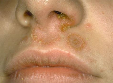 Staphylococcal Infection Symptoms Causes And Treatment