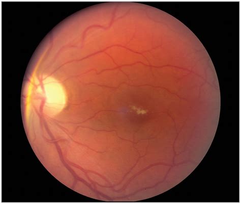 Macular Vitelliform Like Lesion In An Eye With Chronic Retinal