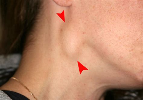 Throat Cancer Lump On Outside Of Neck