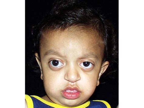 Crouzon Syndrome Pictures