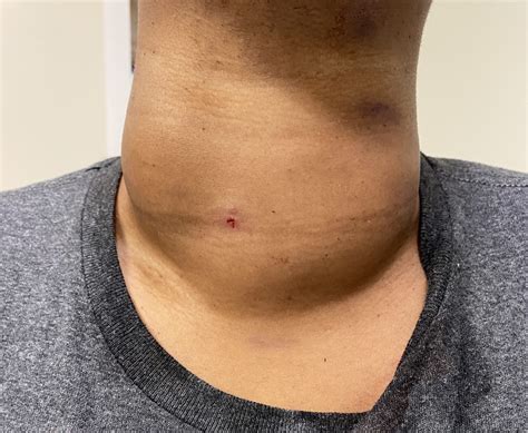 RFA Ablation Of Large Bilateral Thyroid Nodules Goiter Rfathyroidtn Com