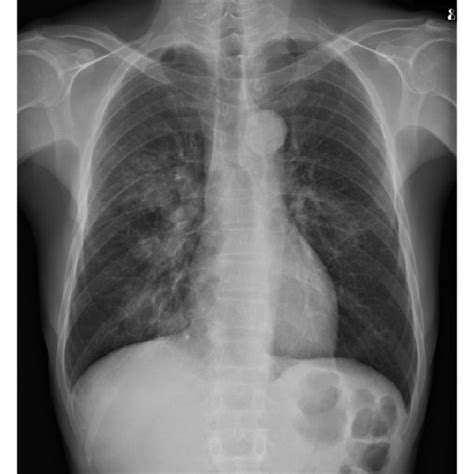 Pathologic Examinations Of Transbronchial Lung Biopsy Specimen With