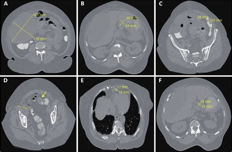 Ct Scans Of Metastatic Cancer With Unknown Primary Site A Large