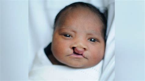 Newborn Undergoes Surgery For Bilateral Cleft Palate In Time For