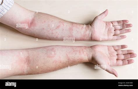 Muestra De Dermatitis Alérgica Por Contacto Brazos Masculinos