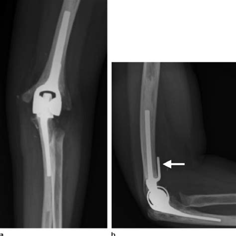Pdf Radiologic Review Of Total Elbow Radial Head And Capitellar